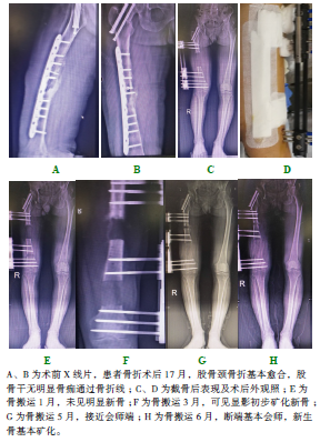 骨搬运技术治疗股骨干骨折术后骨髓炎1例