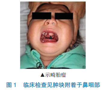 鼻咽部畸胎瘤并腭裂患者1例