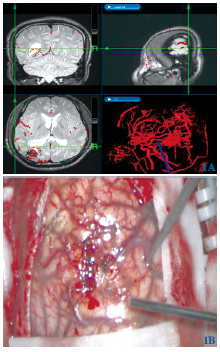 多模态影像融合神经<font color="red">导航</font>在脑动静脉畸形手术的应用