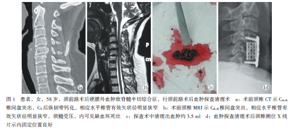 颈前路术后硬膜外血肿致脊髓半切综合征1例