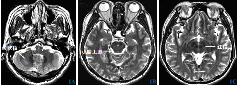 弥散<font color="red">张量成像</font>追踪齿状-红核-丘脑束在脑深部电刺激治疗帕金森病震颤症状的应用