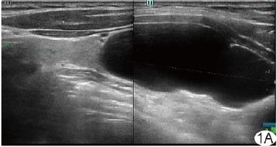 超声误诊无功能性甲状旁腺囊肿1例