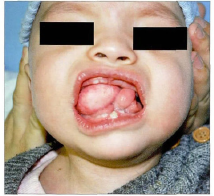 上腭及舌畸胎瘤伴腭裂1例