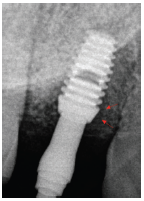上颌骨骨纤维<font color="red">异常</font>增殖症患者牙种植失败1例