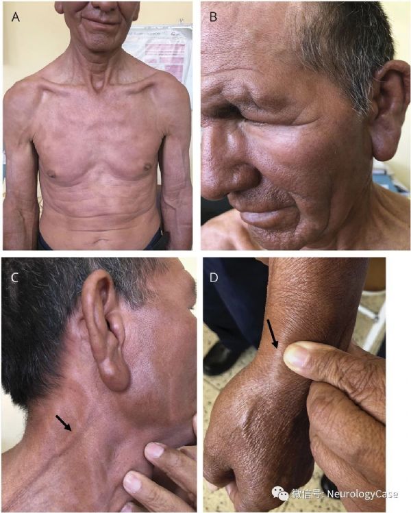 neurology瘤型麻風患者可見增粗的周圍神經