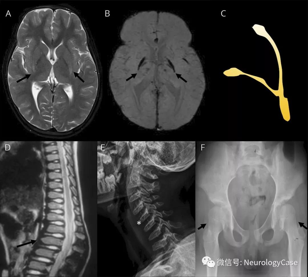 Neurology：叉骨形铁沉积：GM1神经节苷脂贮积症的典型影像学征象