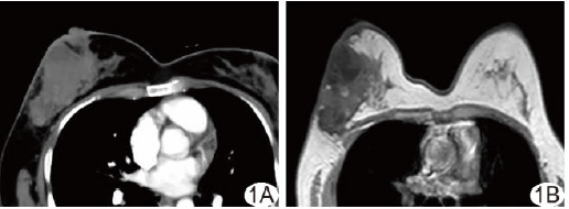 乳腺包被性乳头状癌CT及MRI表现1例