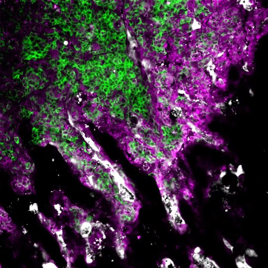 Nat Cell Biol：普林斯顿大学发现了一种可以<font color="red">帮助</font>癌症扩散到骨骼的相互作用