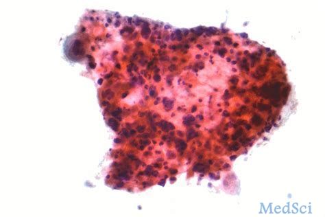 晚期非小细胞肺癌一线治疗新方法：<font color="red">TG</font>4010+Nivolumab+化疗方案的II期试验