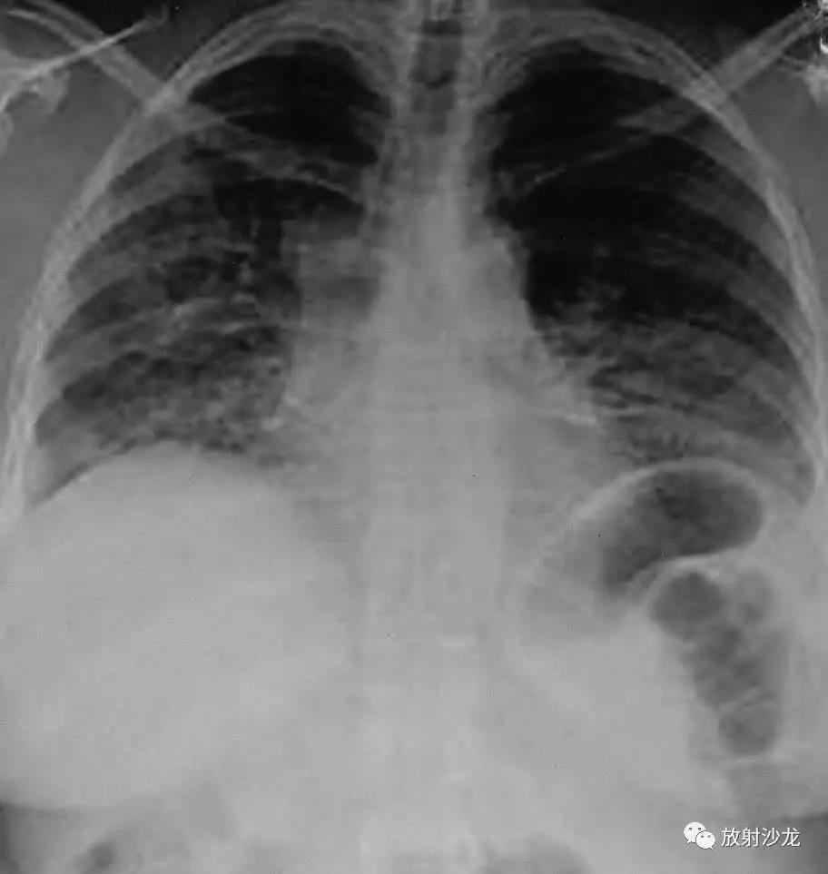 4种原因不明的肺部疾病