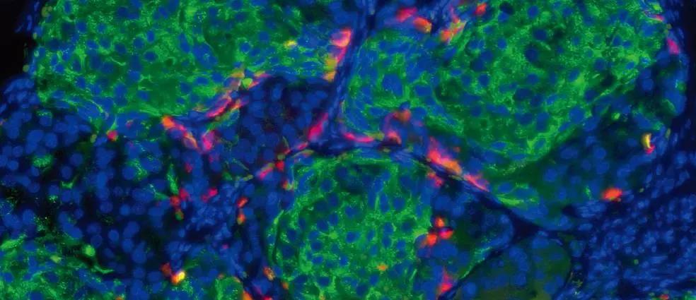 JAMA Oncology：循环肿瘤DNA有望预测结直肠癌的复发