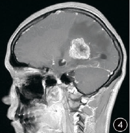 成人<font color="red">脉络</font>丛乳头状癌MRI诊断一例