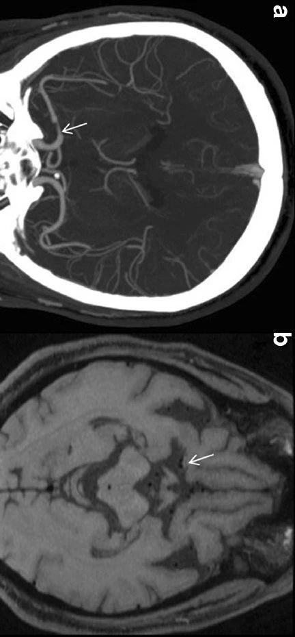 Neuroradiology：两例高分辨血<font color="red">管壁</font> MRI