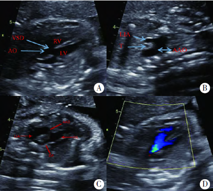 超声诊断镜面右位主动脉弓、左位动脉导管伴法洛四联症1例