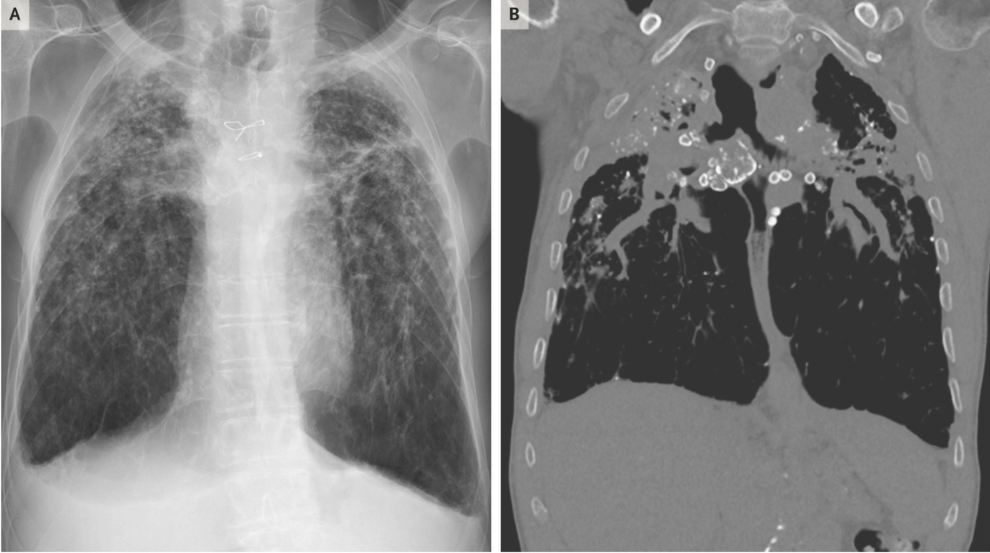 NEJM：慢性矽肺病伴进行性纤维化-病例报道