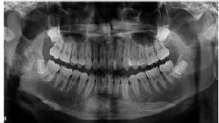 应用3D打印技术修复重建下颌骨骨化纤维瘤切除术后缺损1例