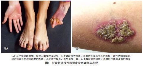 严重残毁的泛发性连续性肢端皮炎一例