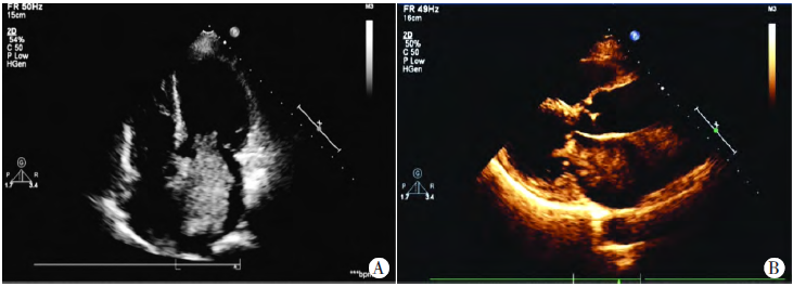 风湿性心脏病合并左房黏液瘤超声表现1例