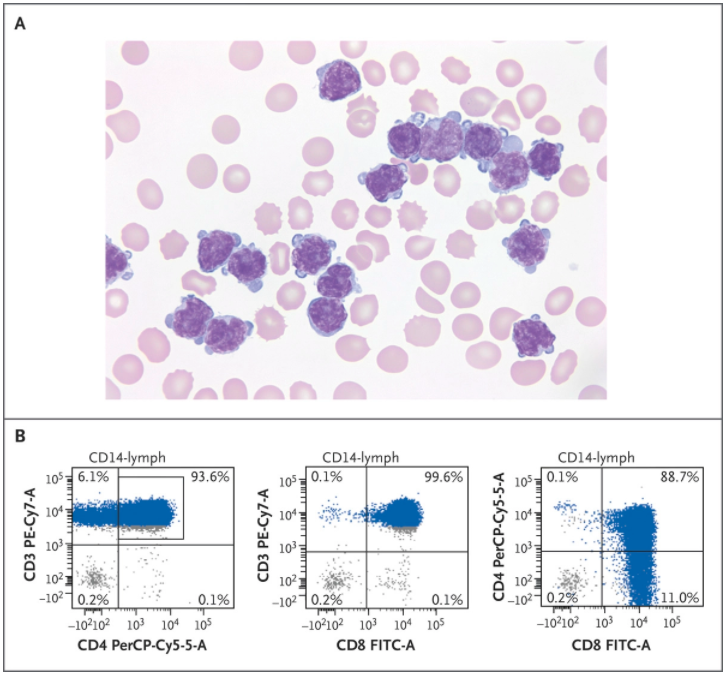 NEJM：T细胞幼淋巴细胞白血病细胞质泡-病例报道