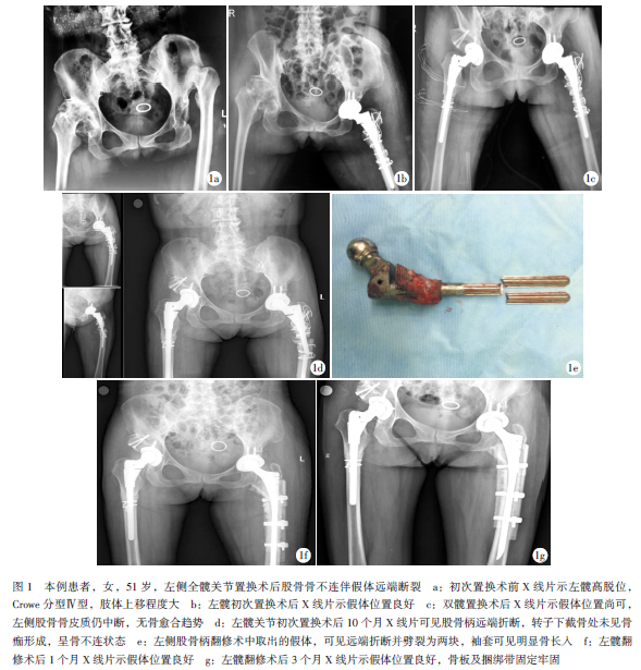全髋关节置换术后股骨骨不连伴假体远端断裂1例