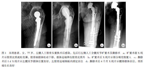 老年骨质疏松患者全髋旷置+翻修术中骨折1例
