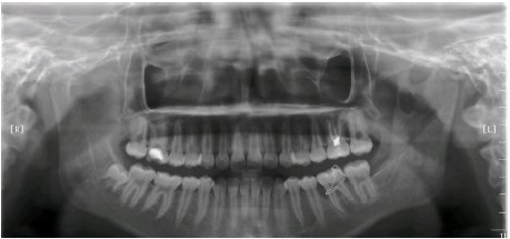 下颌骨髁突及下颌升支巨大单纯性骨囊肿1例