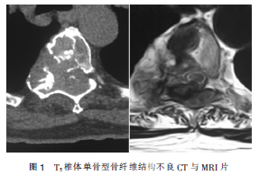 T5椎体<font color="red">骨</font><font color="red">纤维结构</font><font color="red">不良</font>1例