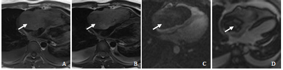 右心原发性血管肉瘤MRI表现1例