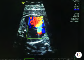 超声诊断胎儿<font color="red">室间隔</font>完整型肺动脉闭锁1例