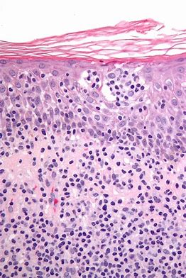 Lancet：IPH4102治疗晚期T细胞淋巴瘤的I期临床试验结果