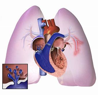 肺动脉高压治疗新药：Sotatercept的PULSAR II期试验已完成患者入组