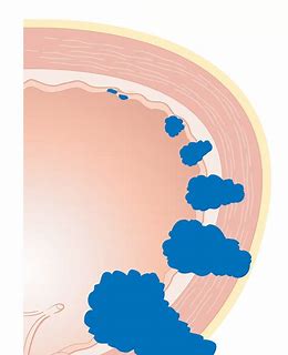 肌层浸润性膀胱癌的治疗：TAR-200在<font color="red">Ib</font>期试验中的阳性结果