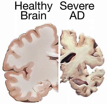 <font color="red">Masitinib</font>治疗阿尔茨海默症的AB09004研究的中期分析结果
