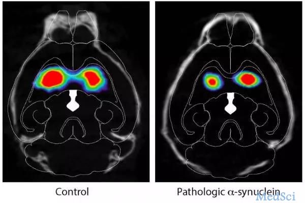 Neuron: 帕金森病可通过肠道-迷走神经扩散至大脑