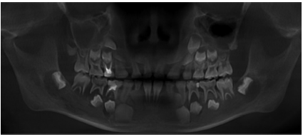 颌骨及上颌窦Burkitt淋巴瘤1例