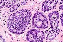 Carcinogenesis：连难搞的三阴性乳腺癌，这个降糖药也能神助攻