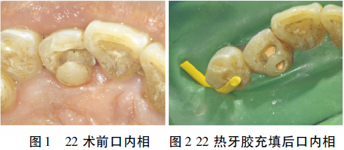 锥形束CT在上颌侧切牙牙中牙诊疗中的辅助应用1例