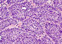 Blood cancer j：IGHV3-48基因的利用情况有望用于预测滤泡性淋巴瘤患者组织学转化的风险
