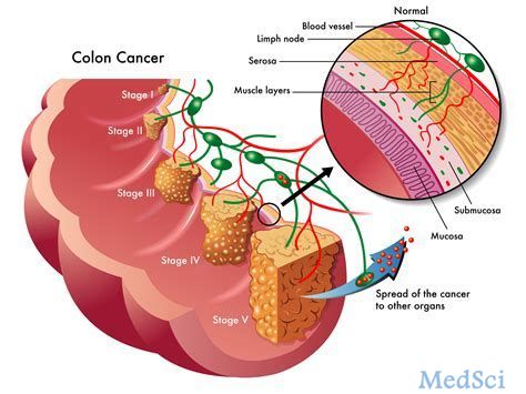 ESMO世界胃肠癌大会：murlentamab的II期临床<font color="red">研究结果</font>