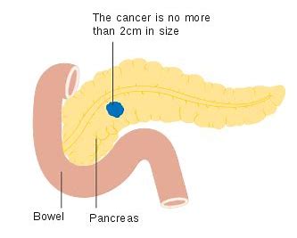 ESMO世界胃肠癌大会：评估脂质体伊立替康作为转移性胰腺癌一线疗法的I/II期临床研究