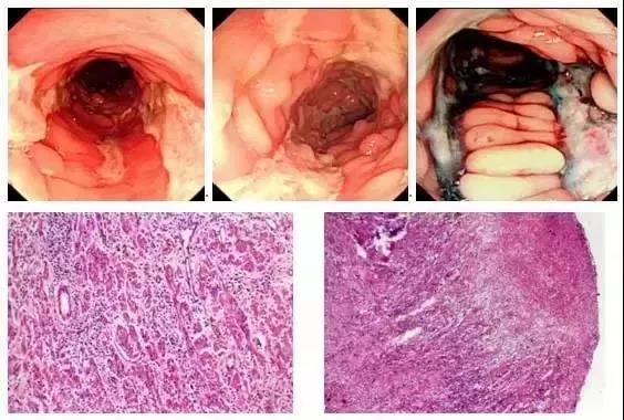 六种肠道消化溃疡性疾病的内镜鉴别诊断