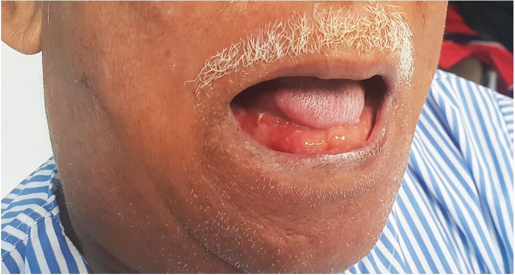 NEJM：卢德维希咽峡炎的“双舌”现象-病例报道