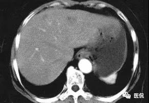 反复腹痛恶心，肝<font color="red">的</font>问题：增强CT看见肝内有结节，是什么？