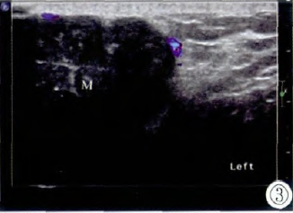 男性乳房毛母细胞瘤超声表现1例