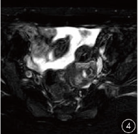 子宫肌壁间妊娠MRI表现一例