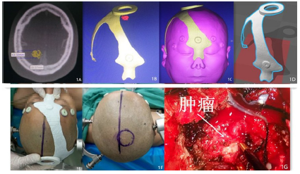 3D打印技术在脑膜瘤术前定位中的初步应用