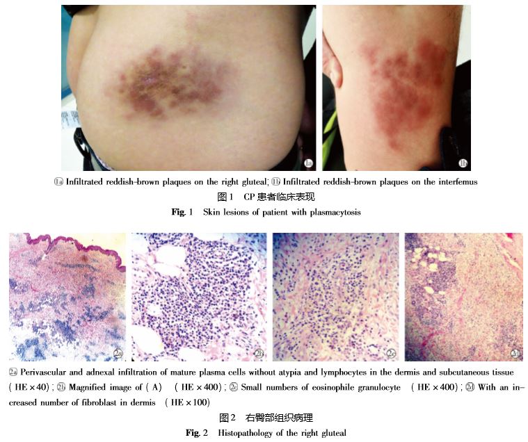 血清 γ 球蛋白正常的皮肤浆细胞增多症1 例