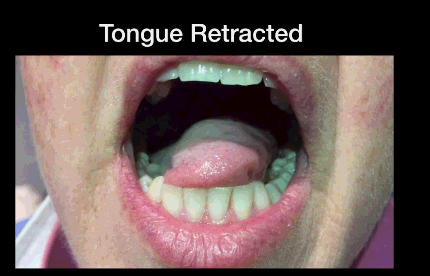 颏舌肌收缩图片