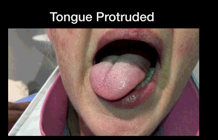 颏舌肌收缩图解动态图片