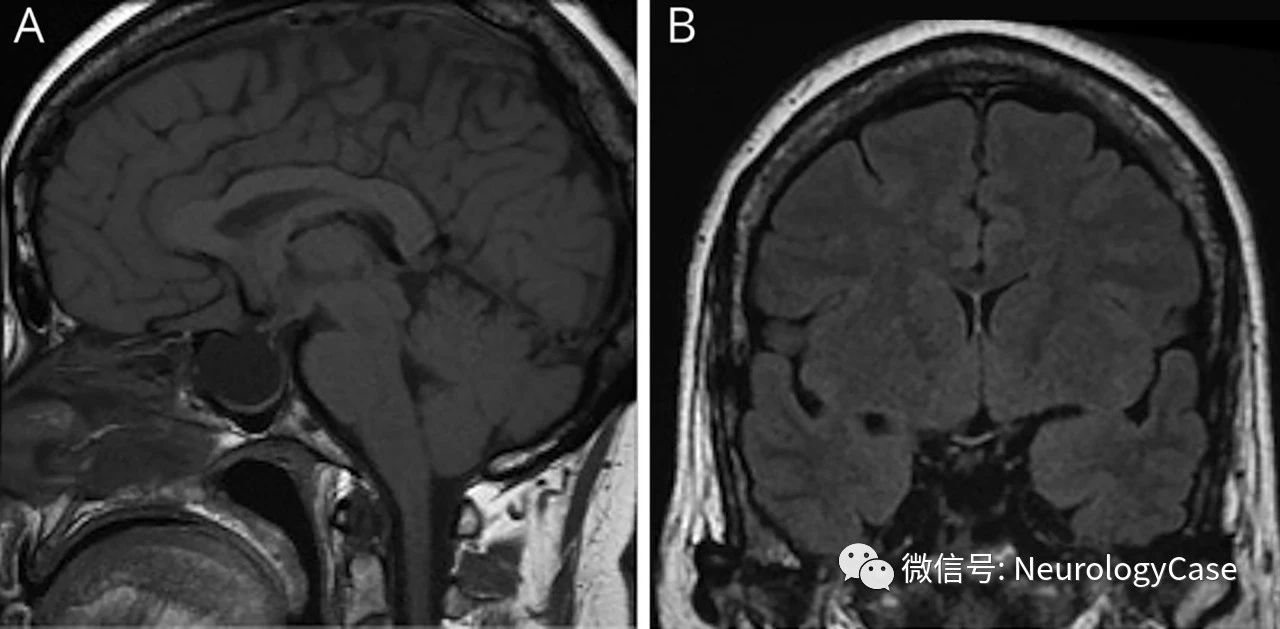 Neurology：伴横窦和乙<font color="red">状</font>窦狭窄的乳突骨瘤可致假性脑瘤